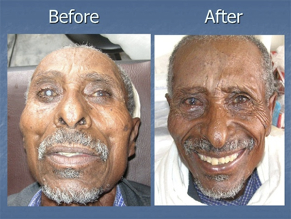Cataract Surgery
